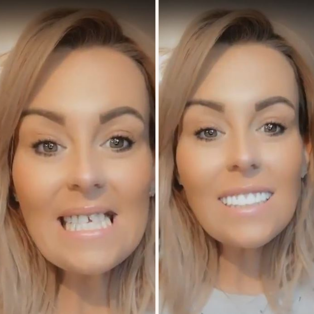 Great Smile Veneer