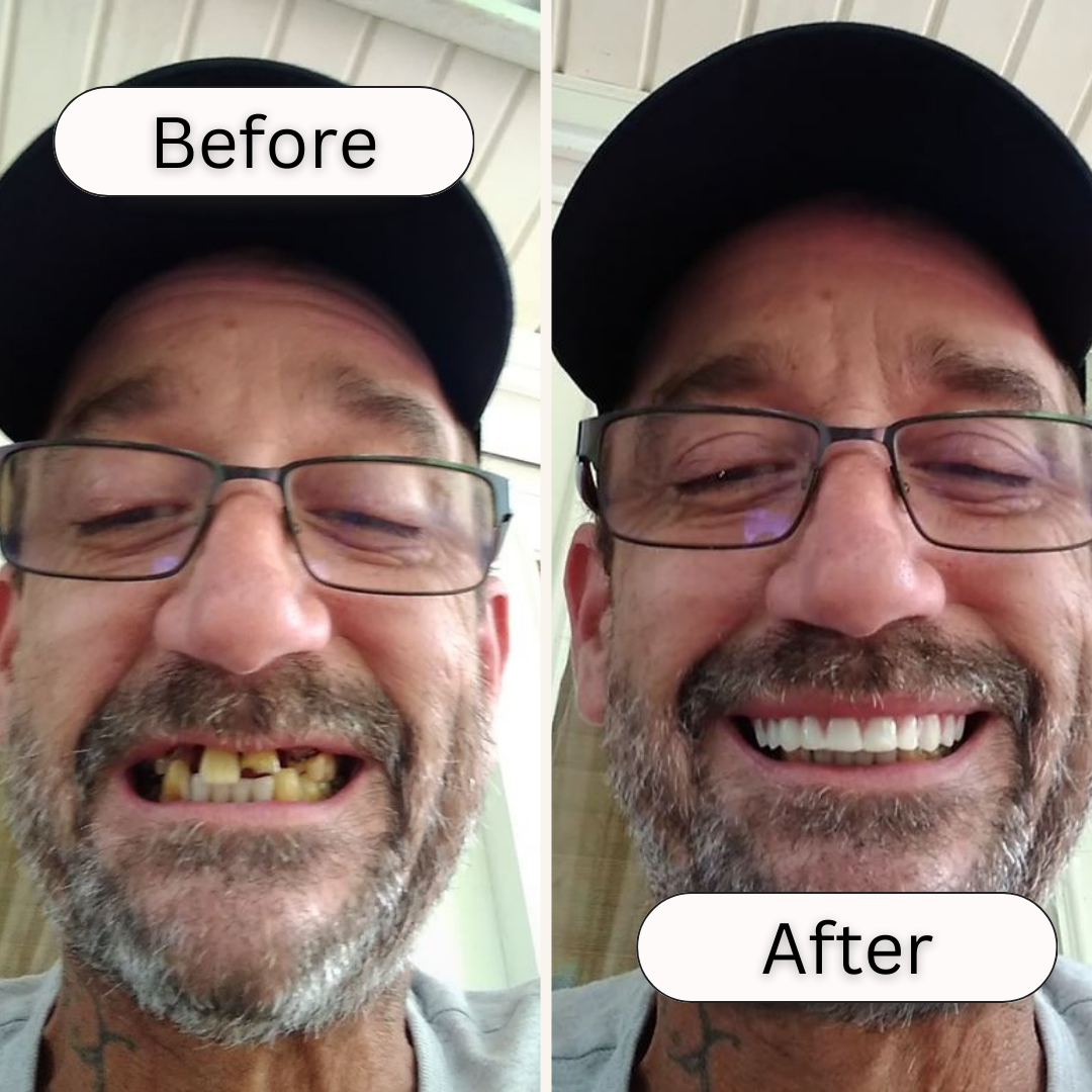 Great Smile Veneer