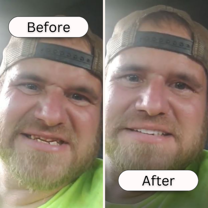 Great Smile Veneer