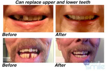 Multi-Shade Temporary Tooth Replacement Kit - mutli-shade-temporary-tooth-replacement-kit