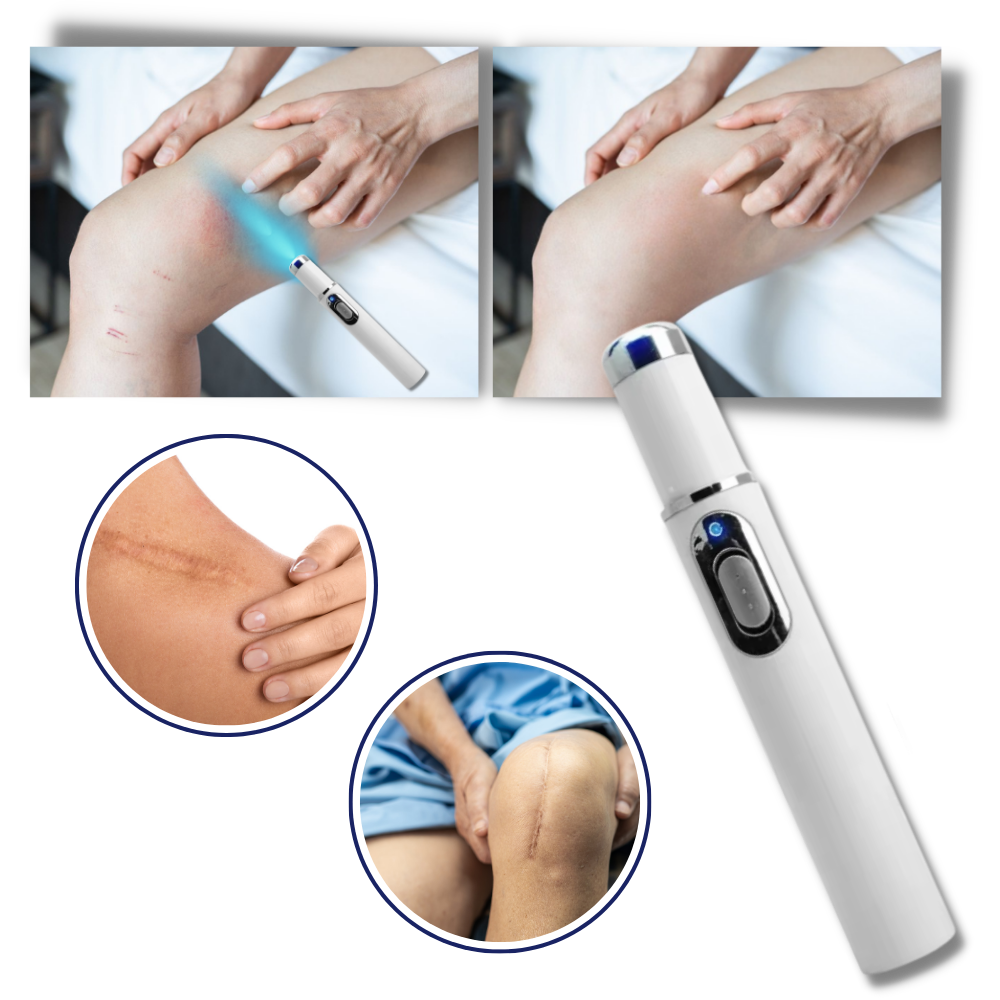 LumaGlow™ Dark Spot Remover Pen - Blue Light Laser Treatment for Skin Blemishes