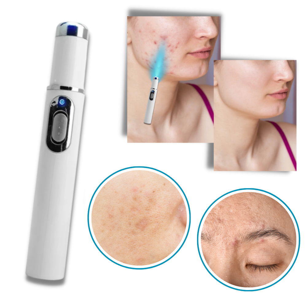 LumaGlow™ Dark Spot Remover Pen - Blue Light Laser Treatment for Skin Blemishes