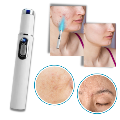 LumaGlow™ Dark Spot Remover Pen - Blue Light Laser Treatment for Skin Blemishes