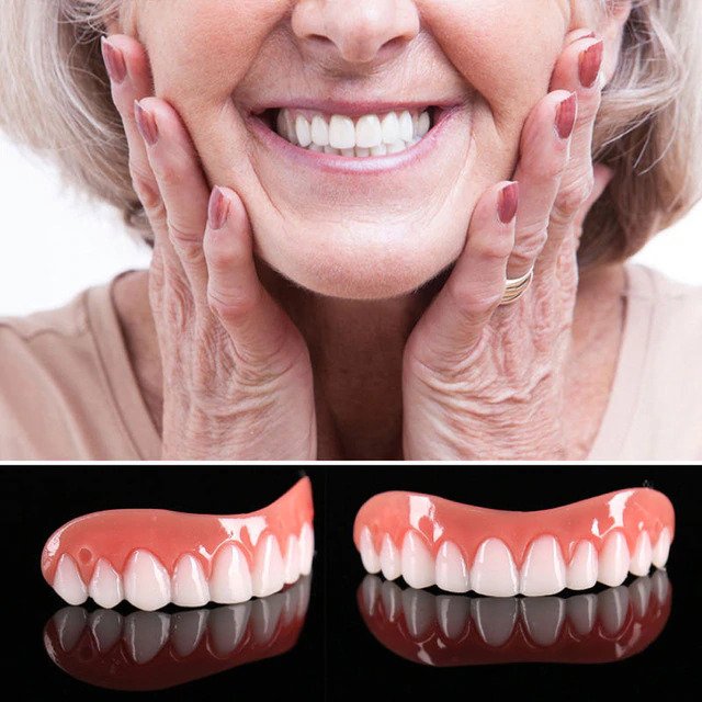Great Smile Veneer (Upper Only)